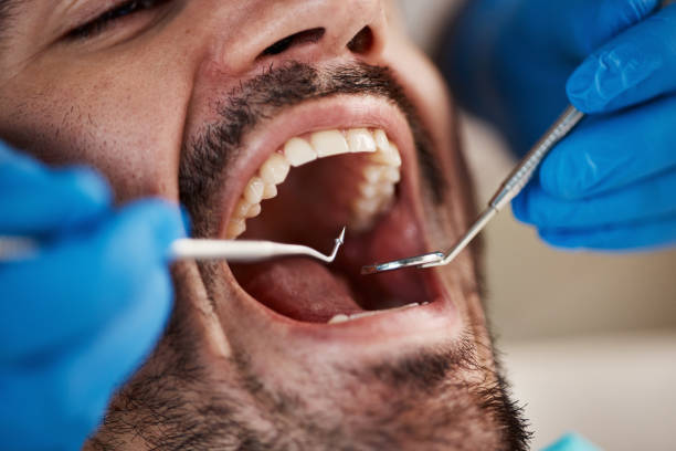 Best Emergency Dentist for Lost Fillings or Crowns in Rapid City, MI